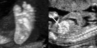 Ketika mengandung anak kedua kami, saya dapat merasakan tekanan daripada mertua yang mengharapkan seorang anak lelaki kerana kami sudah memiliki anak perempuan. Ini Antara Sebab Kenapa Detail Scan Untuk Bayi Lebih Penting Dari Scan 3d4d5d