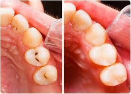 This can give off an odor that can smell like sulfur or rotten eggs. Dental Filling Procedure