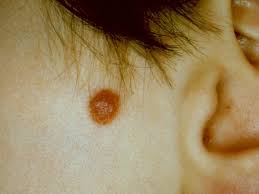 Image result for Spitz Nevus