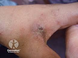 Image result for human scabies