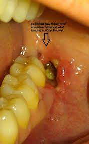 Within 24 hours of extraction, you should see a colored clot at the site (the place where the tooth was extracted). Dry Socket Dental Clinic In Delhi