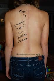 Sami S Scoliosis Story Scoliosis Scoliosis Exercises Spinal Fusion