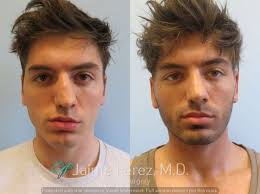 We did not find results for: 22 Year Old Male Rhinoplasty Nose Job Rhinoplasty Before And After Gallery
