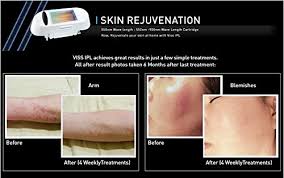 As we develop this blog we will continue to search for new reviews and include them as new posts. Viss Ipl 3in1 Paket Haarentfernung Hautverjungung Fleckenbehandlung Amazon De Beauty