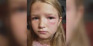 Tallulah mother furious after daughter claims she was bullied, sent home  with a bruised eye