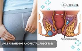 Image result for Ischiorectal Abscess