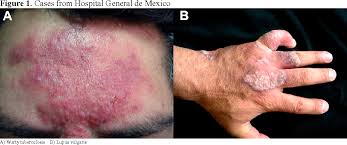 Tuberculosis verrucosa cutis is a form of cutaneous tuberculosis that occurs after direct inoculation of the mycobacteria into the skin of a previously sensitized host with moderate to high immunity against the bacillus. Figure 1 From Skin Biopsy A Pillar In The Identification Of Cutaneous Mycobacterium Tuberculosis Infection Semantic Scholar