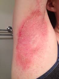 Candida infection (candidiasis) can cause or aggravate intertrigo, an inflammatory rash arising in body folds. Armpit Rash Itchy Candida Causes Treatment