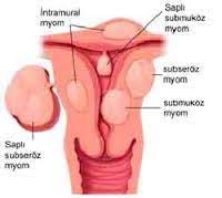 Progestin diberikan secara oral, dalam suntikan, dalam alat kontrasepsi, atau sebagai krim vagina. Obat Penebalan Dinding Rahim Cara Terbaik Mengobati Penebalan Dinding Rahim