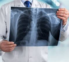 Riscul crește o dată cu lungimea perioadei în care se fumează și numărul de țigări. Raceala La Plamani Despre ViaÈa Din Romania