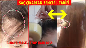 Kesinlikle Ise Yariyor Zencefili Sur Sac Dokulmesini Durdur Sac Cikartan Dogal Tarif Saccikartan Youtube