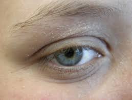 Eyelid dermatitis, also known as periocular dermatitis or periorbital dermatitis, presents with a scaly seborrheic dermatitis — seborrheic dermatitis is a chronic, relapsing form of dermatitis that has a predilection for nasolabial creases, eyelids, ears, scalp, chest, and intertriginous sites. Eyelid Contact Dermatitis Dermnet Nz
