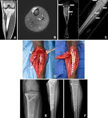 A report from the childrens oncology group bone tumor committee. Review Of Osteosarcoma And Current Management Springerlink