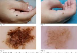 Image result for Spitz Nevus