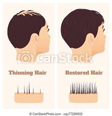 When the balance is interrupted — when hair falls out and less hair grows in — hair loss happens. Woman In Side View Before And After Hair Loss Treatment Woman With Thinning Hair Before And After Hair Loss Regrowth Female Canstock
