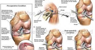 Superb Tricks For Cpt Code 29881 29880 And 29877 Medical Coding Guide How To Code Cpt Codes Cpt Medical Coding