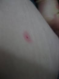 Image result for flea bite