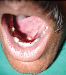 Image result for Sialolithiasis