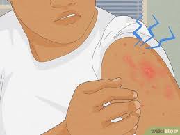 Image result for scabies on humans