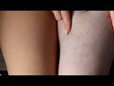 How to Cover up Stretch Marks New Health Guide