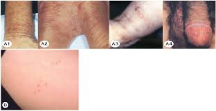 Image result for scabies human bites