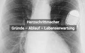 Herzschrittmacher Grunde Ablauf Lebenserwartung Praktischarzt