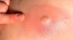 Orange spots on my hands. Pimple On Your Hand Main Causes And Treatments