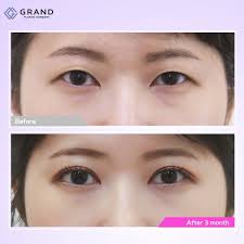 Natural Results After Having Grand S Double Eyelid Surgery Natural Adhesion Method Full Incision Method Plastic Surgery Eyelid Surgery Plastic Surgery Korea