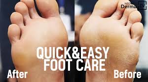 'you wouldn't consider exfoliating the face without following with a moisturiser. Fast And Easy Care To Remove Cracked Heels Foot Dead Skin Cells Youtube
