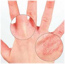 Ekcem Na Rukama Kod Odraslih Dece Slike Lecenje Soins De Beaute Sante Beaute Traitement De L Eczema