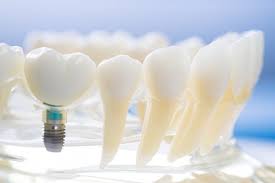 How Long Do Dental Implants Take To Heal Delta Dentist