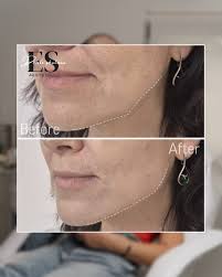 Instagram photo by Dr Eli Shulman • aesthetic & beauty • Jan 2, 2025 at  2:05 AM