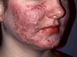 Image result for demodex rosacea