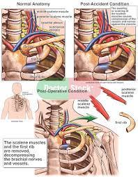 Thoracic Outlet Syndrome With Resection Of The First Rib And Scalene Muscles Doctor Stock Anatomy Thoracic First Rib