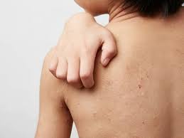 Image result for dermatitis contacta children