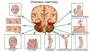 Opuhol Golovnogo Mozga Simptomy Na Rannih Stadiyah U Vzroslogo Priznaki