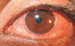 Image result for Vernal Conjunctivitis