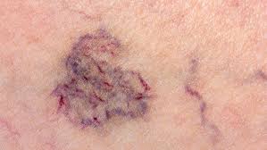 It's good to know the risk factors. Trombose Drauzio Varella Drauzio Varella