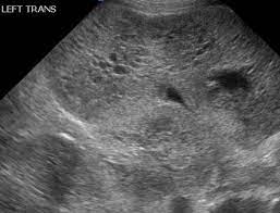 Autosomal Recessive Polycystic Kidney Disease Radiology Reference Article Radiopaedia Org