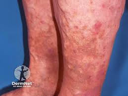 Image result for allergy rash on the legs