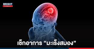 Oct 17, 2021 · อาการที่อาจบ่งชี้ถึงเนื้องอกในสมอง หรือมะเร็งสมอง. Pji4stdhemkqpm