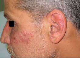 Herpes is a mild condition that causes small sores to appear on the skin. Disseminated Primary Hsv 2 Infection Of The Face