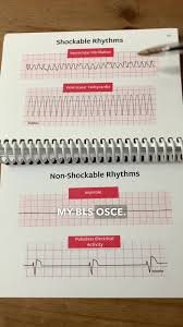 Image result for Pulseless Electrical Activity