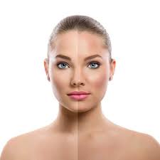 Chemical Peel Southend-on-Sea, Essex by Body Aesthetics