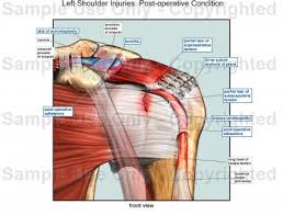 We'll need to master this before we include muscles. Left Shoulder Injuries Post Operative Condition Medical Illustration Human Anatomy Drawing Anatomy Illustration