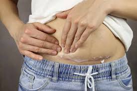 C-Section Massage: Why and How Should You Do It