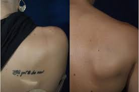Presenting a guide on tattoo removal, including diy tattoo removal at home (which we don't recommend). Is Laser Tattoo Removal Painful Rockwall Laser Tattoo Removal Juvanew Medspa
