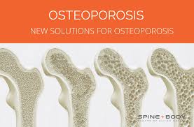 It is the most common reason for a broken bone among the elderly. New Solutions For Osteoporosis Spine And Body