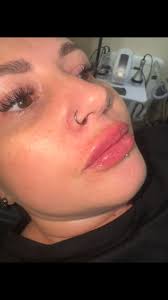 Lip and tox today for this beautiful lady 😍book your appointment today  📍23 Nelson street Consett #skinboostertraining #polynucleotides  #polynucleotides #skinboostertraining #chemicalpeels ...