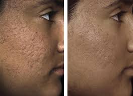 Vor der behandlung video 3:die behandlung selbst video 4: Laserbehandlung Solta Fraxel Re Fine Leila Beauty Ipl Shr Dauerhafte Haarentfernung Fraxel Laser Apparative Kosmetik